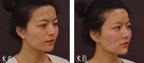 明星注射苹果肌,苹果肌注射，重塑青春轮廓